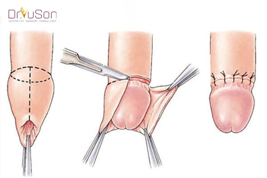 Cắt bao quy đầu là như thế nào?