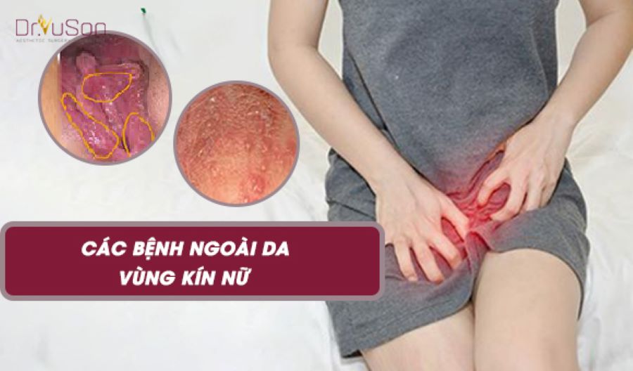 Các Bệnh Ngoài Da Ở Vùng Kín Nữ Giới: Nguyên Nhân, Dấu Hiệu Và Phương Pháp Điều Trị Hiệu Quả