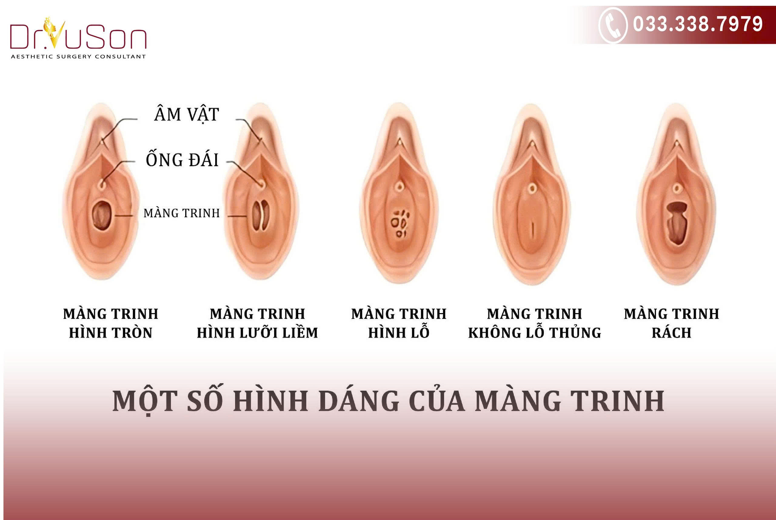 Màng trinh có nhiều hình dạng và cấu tạo khác nhau