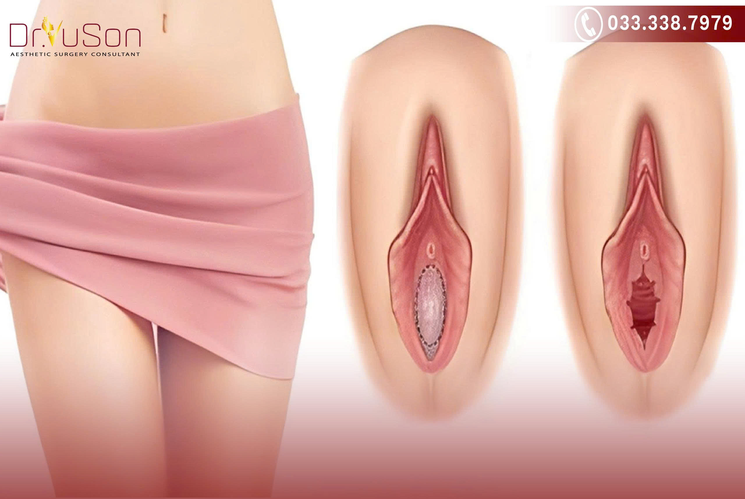 Màng trinh nằm ở chỗ nào?