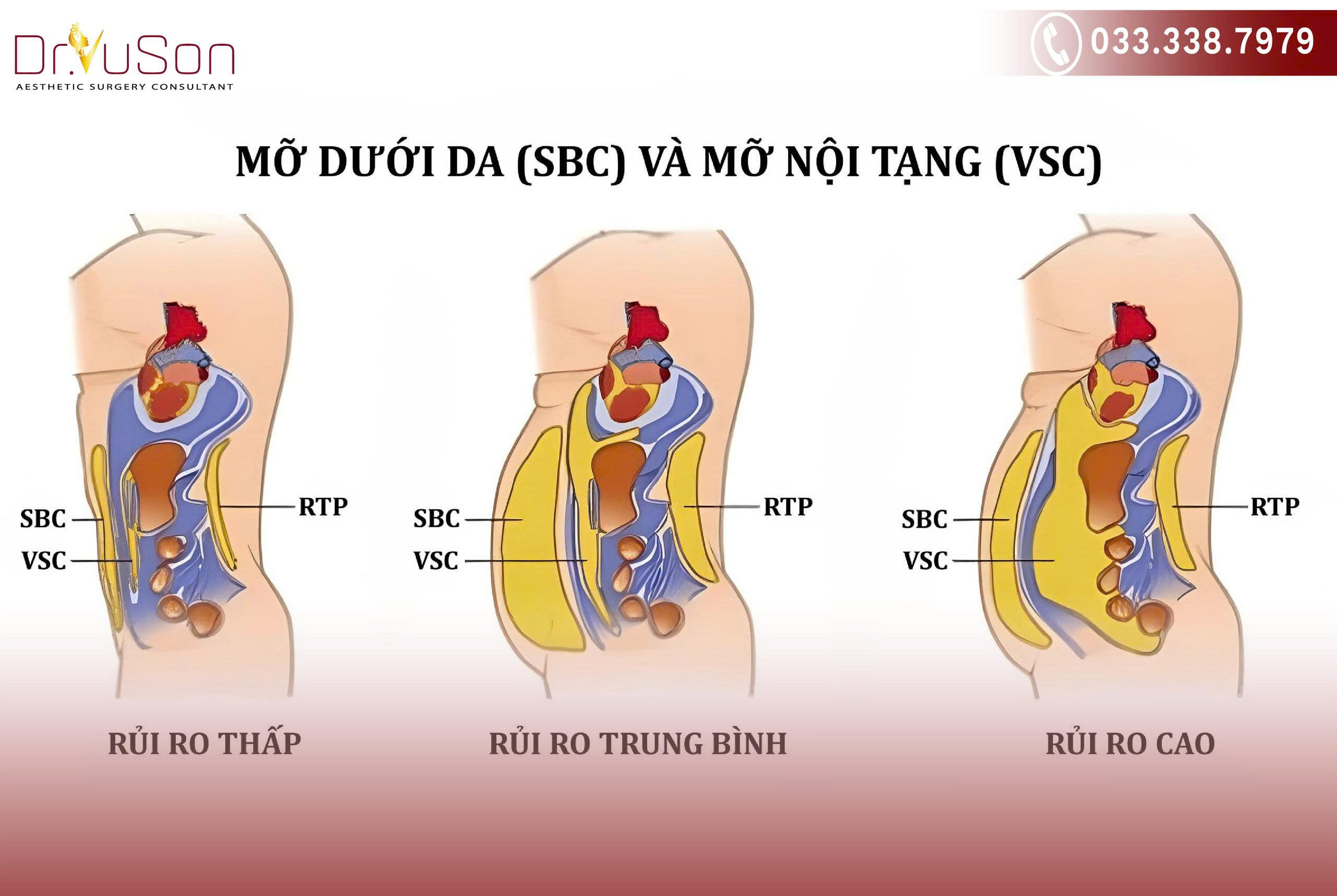 Khi mỡ nội tạng tích tụ quá nhiều, nó làm tăng vòng bụng