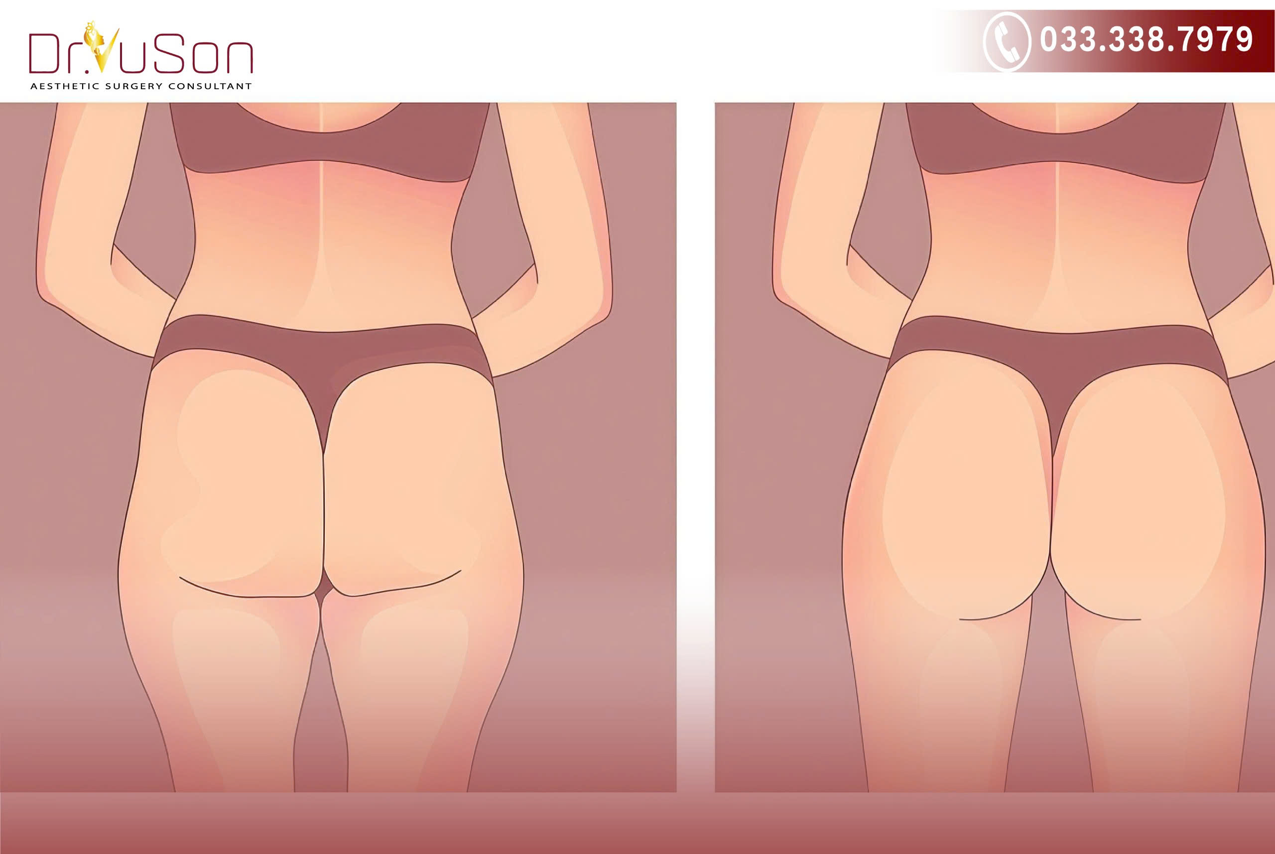 Hình ảnh trước và sau khi nâng mông