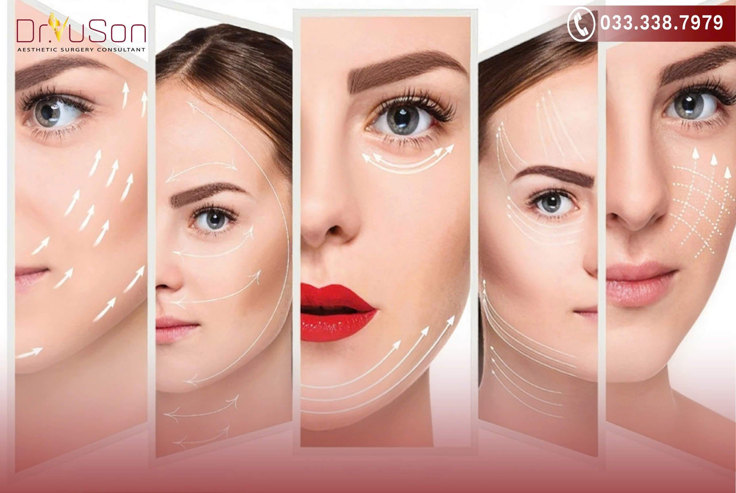 Cấy chỉ Collagen giải pháp trẻ hóa da lão hóa nhẹ đến trung bình