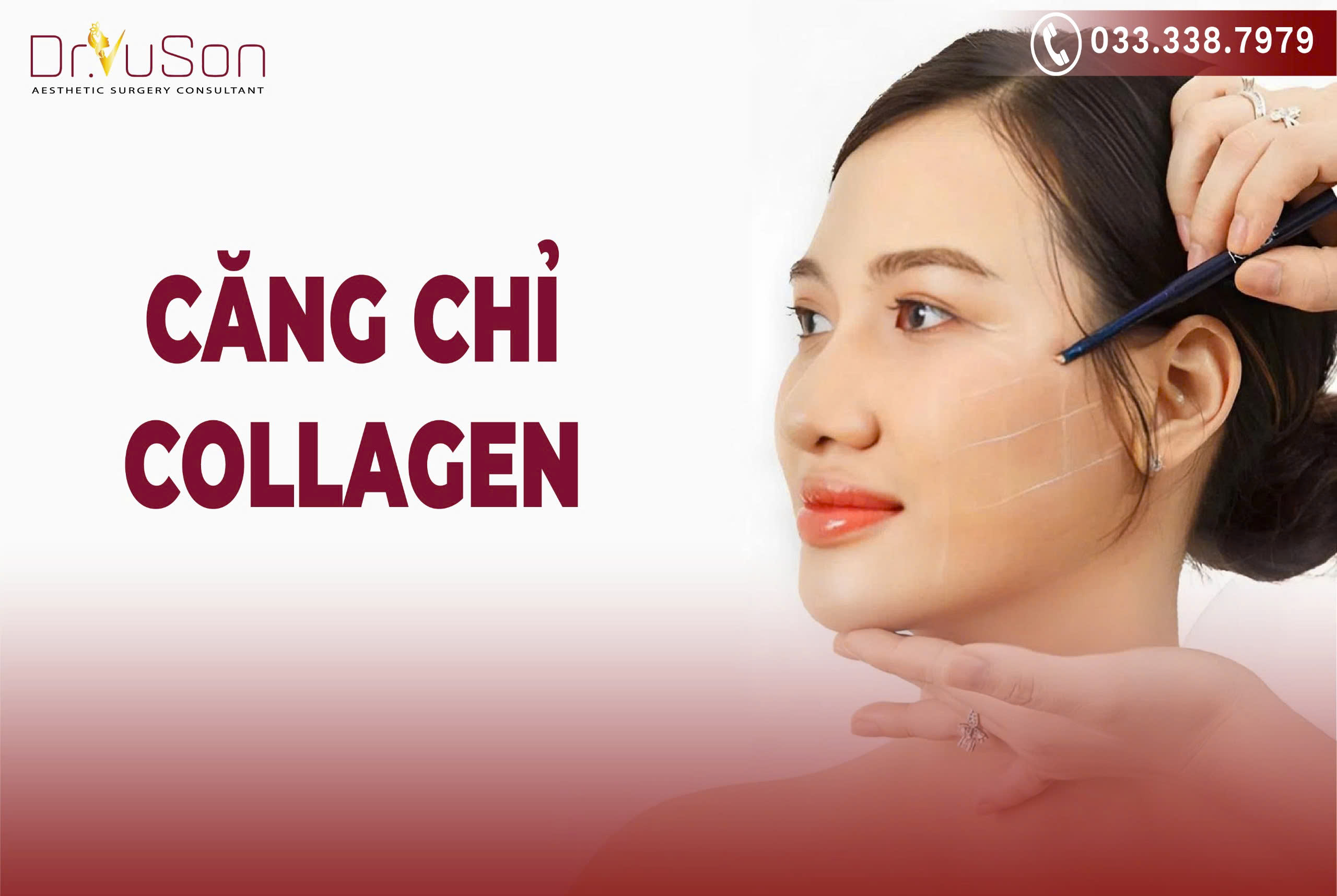 Căng chỉ Collagen là một phương pháp trẻ hóa da không phẫu thuật