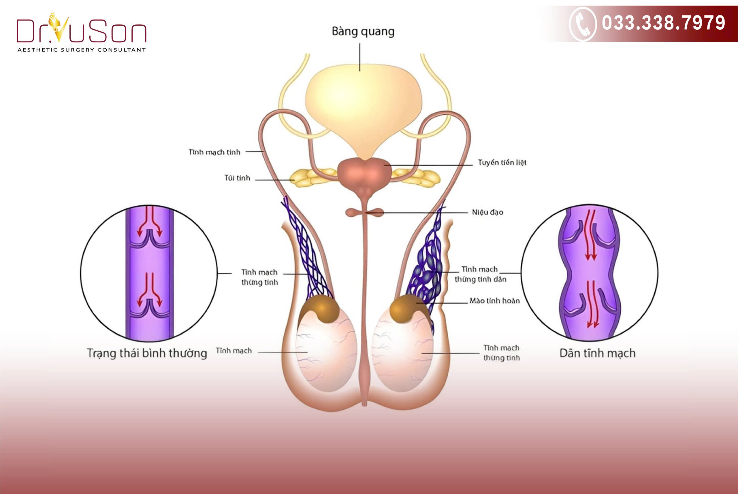 Các tĩnh mạch trong thừng tinh bị giãn nở và xoắn lại