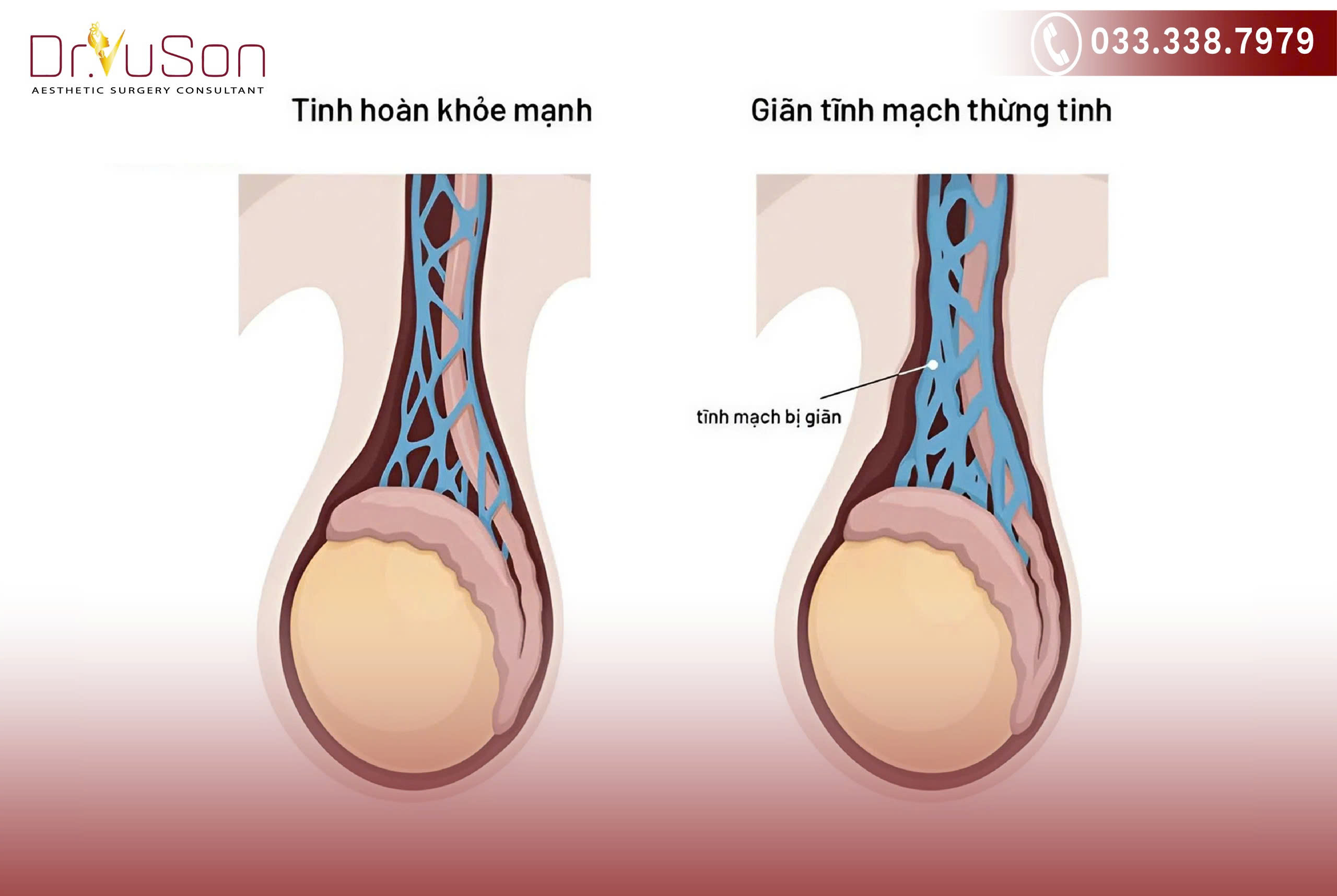 Sờ thấy búi tĩnh mạch giãn phía trên tinh hoàn