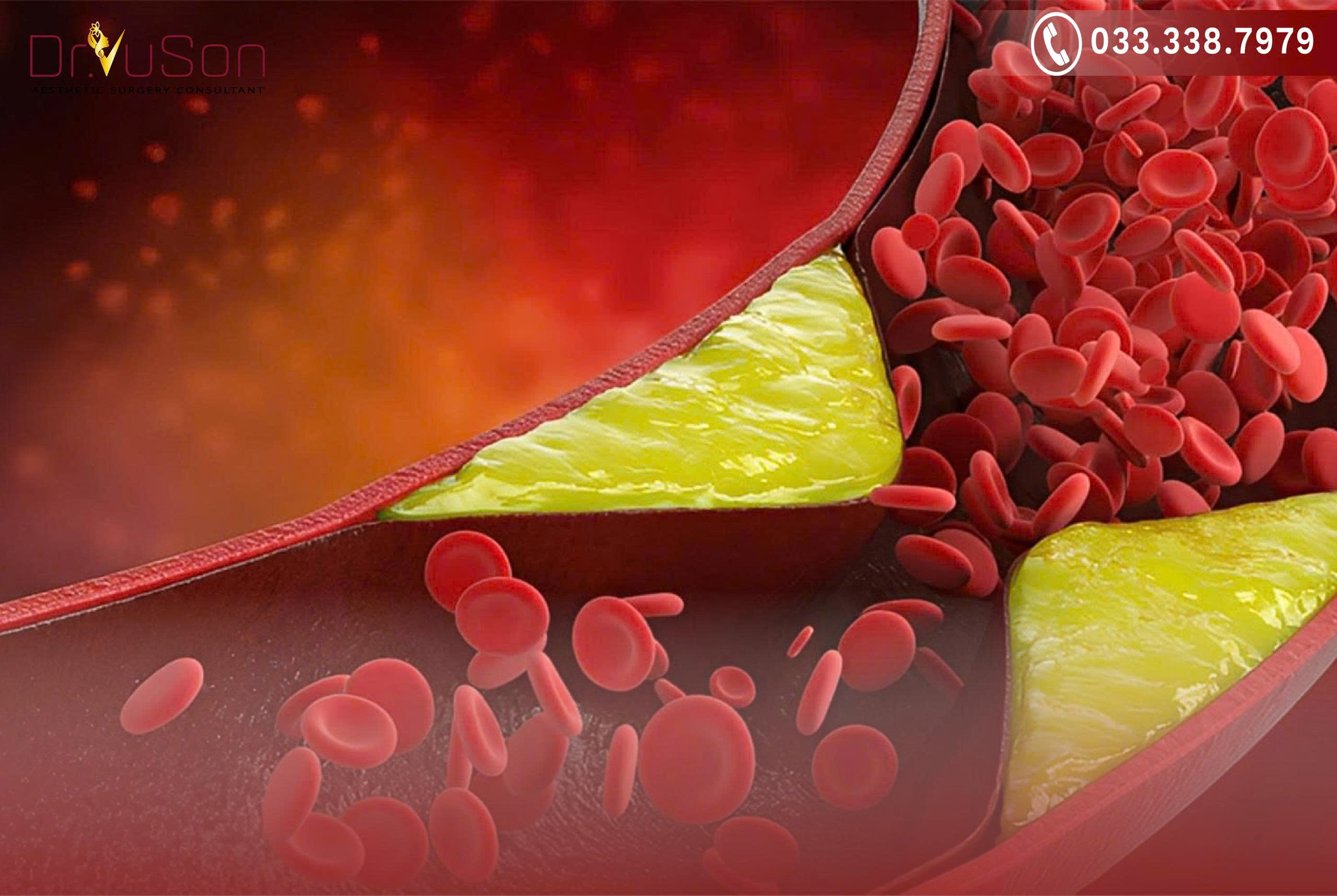 Cần lưu lượng máu đủ lớn được bơm vào các thể hang