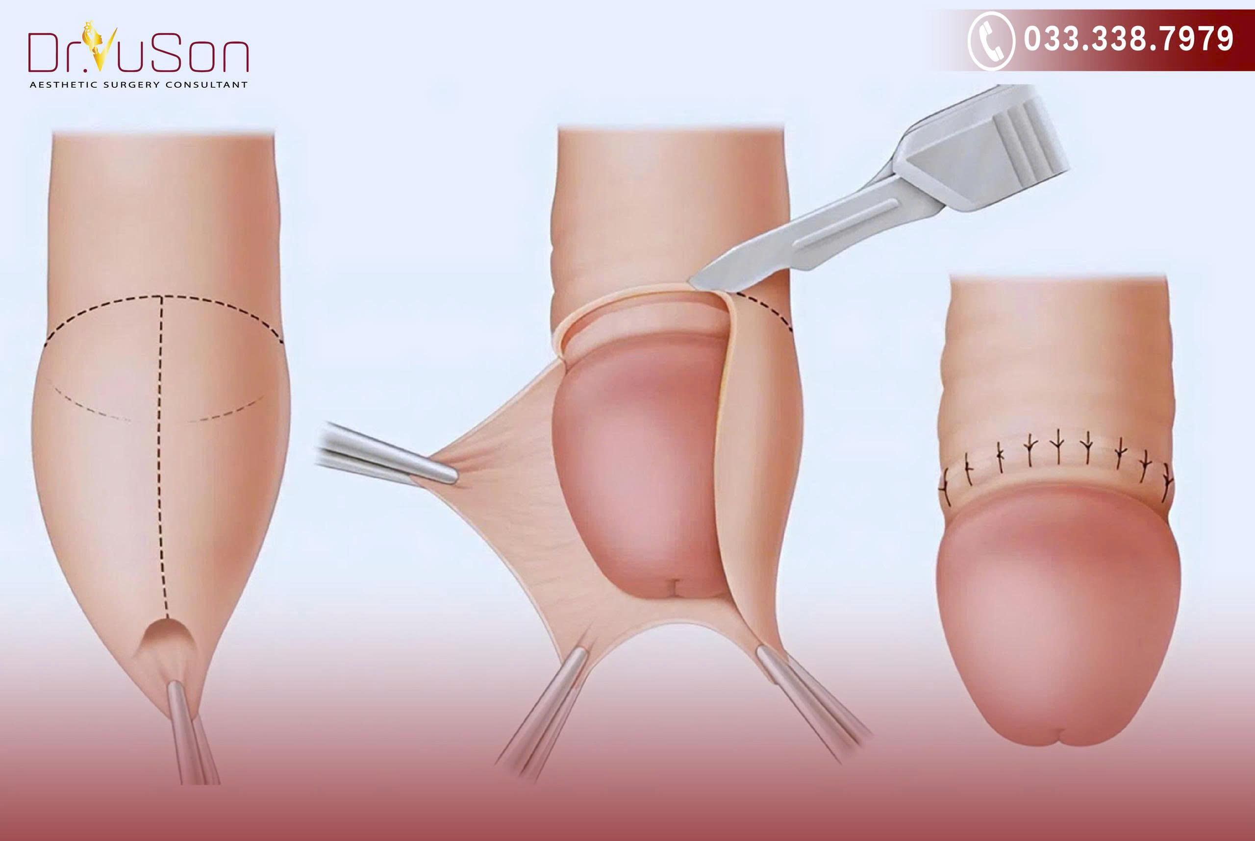 Tỷ lệ xuất hiện chuỗi hạt ngọc cao hơn đáng kể ở những người chưa cắt bao quy đầu