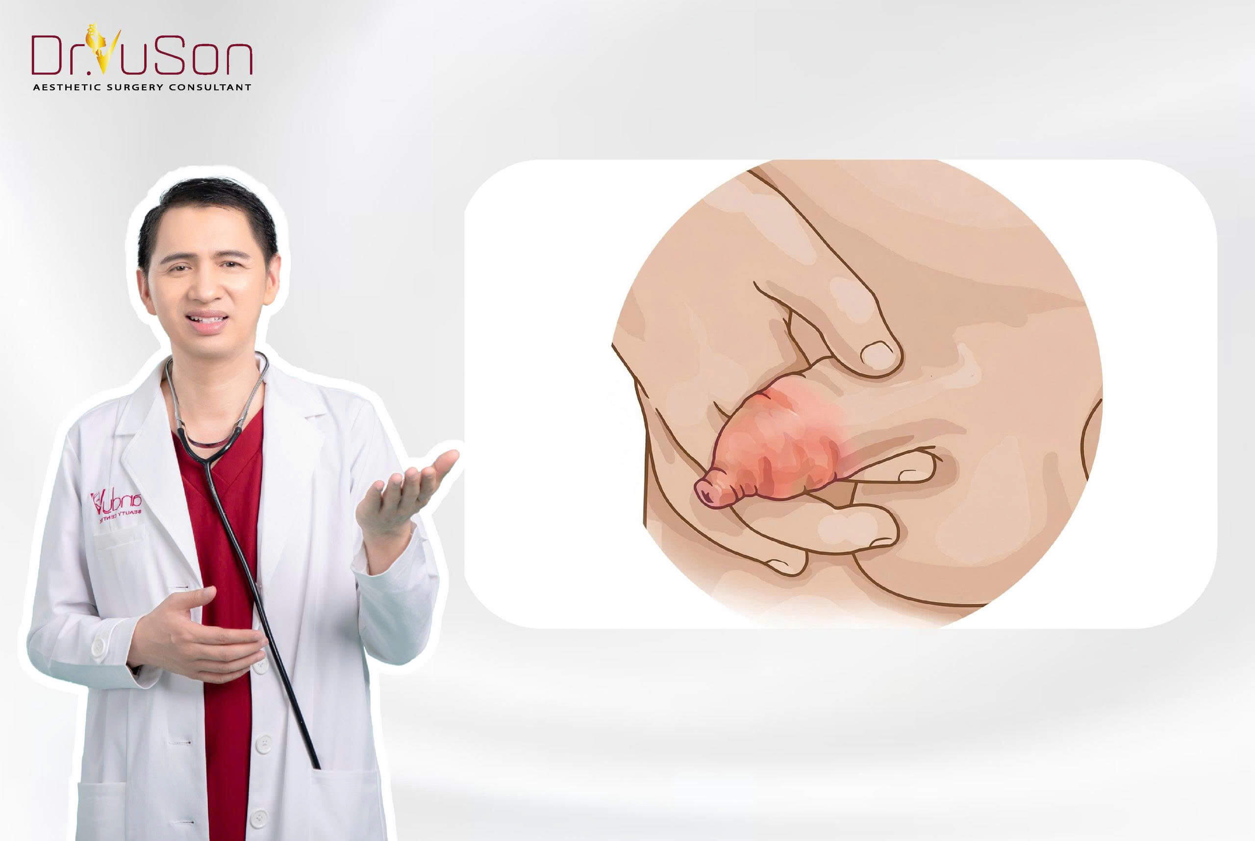 Bao quy đầu dài có thể gây viêm nhiễm nghiêm trọng