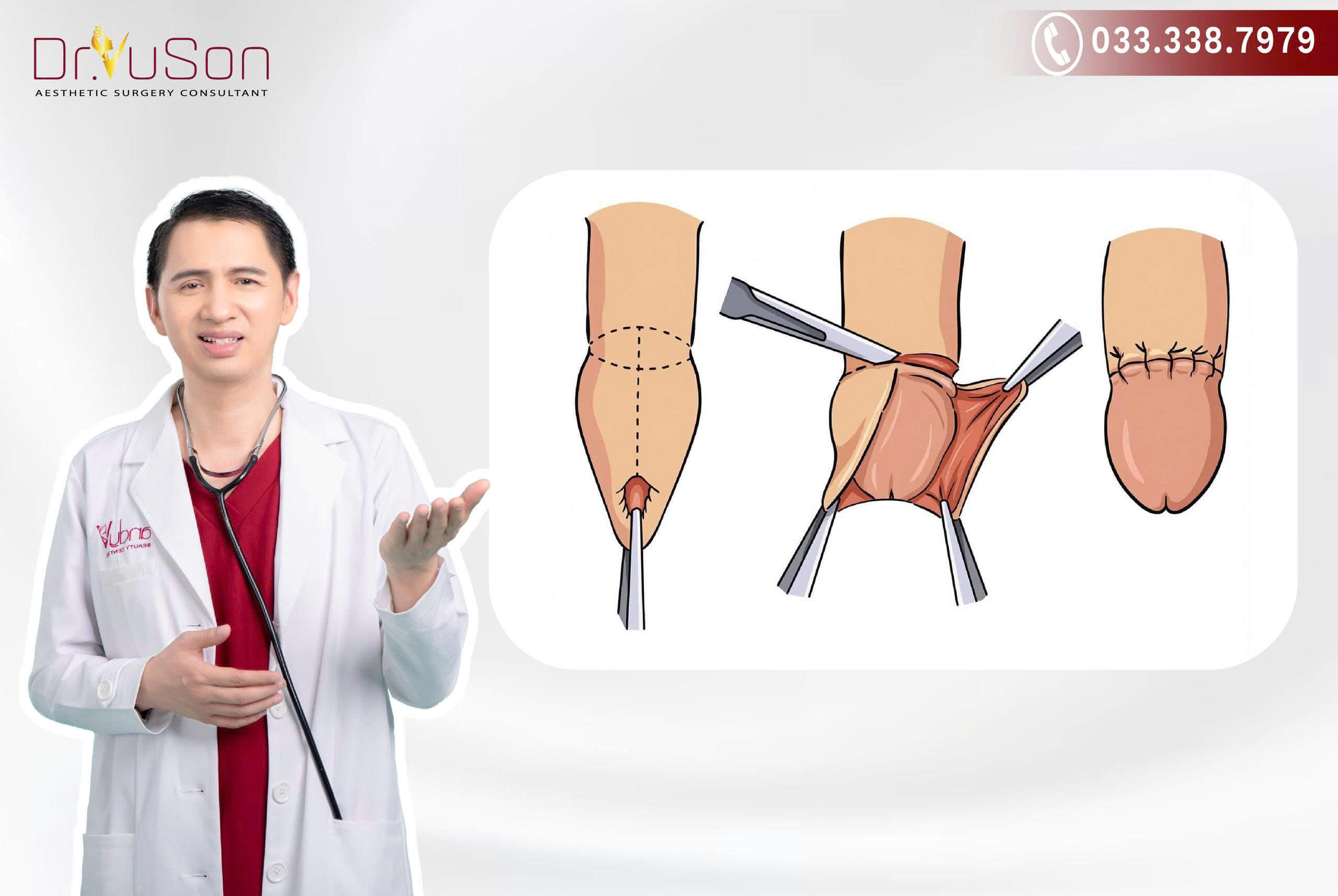 Hình ảnh minh họa các bước thực hiện phương pháp cắt bao quy đầu truyền thống an toàn tại Bác sĩ Vũ Sơn